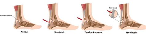 Doctor for Achilles Tendonitis in Ghaziabad, Insoles to treat Achilles ...