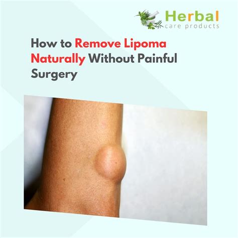 How to Remove Lipoma Naturally Without Painful Surgery - Herbal Care Products - Blog