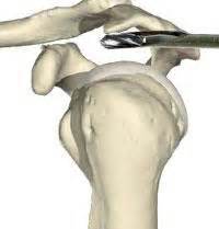 Image result for Subacromial Decompression Rotator Cuff Repair