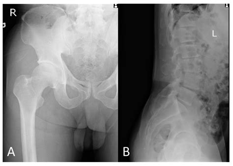 A Swollen Inferior Gemellus Muscle with Hematoma Mimics Sciatica—A Case ...