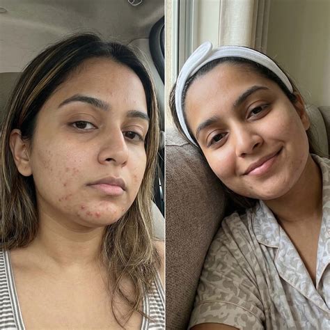 Acne Clear Powder for Hormonal Acne & Gut Health | Setu – Setu Nutrition