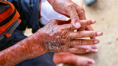 A Comprehensive Guide to Scleroderma – Caresupp.in