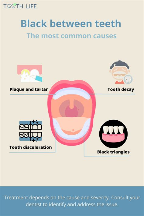 What causes blackness between my teeth? How can I get rid of it?