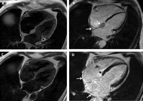 Atrial Giant Cell Myocarditis | Circulation