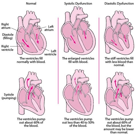 Overview of Heart Failure - Heart and Blood Vessel Disorders - Merck Manual Consumer Version