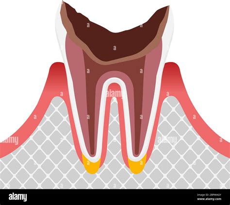 Molar tooth decay hi-res stock photography and images - Alamy