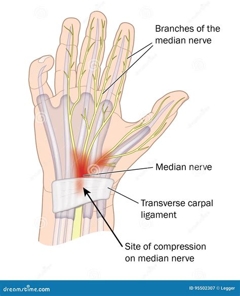 Carpal Tunnel Syndrome Cartoon Vector | CartoonDealer.com #95502307