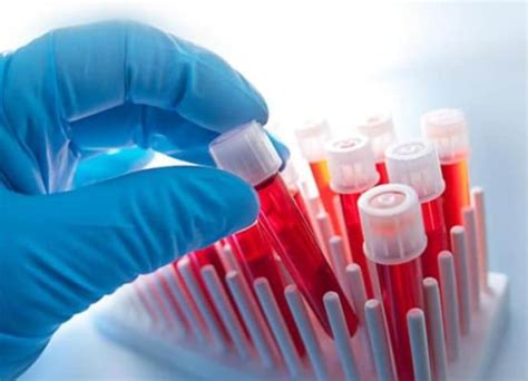 Anion Gap Test: अनायन गैप टेस्ट क्या है? प्रक्रिया, टेस्ट से पहले ...