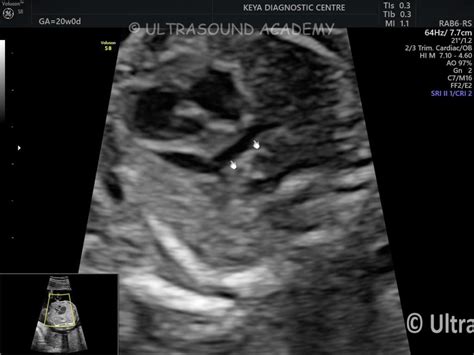 TAPVC SUPRACARDIAC TYPE – Case By Dr. Nitin Jadhav