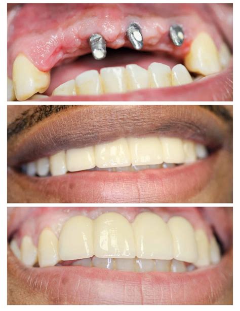 Front Teeth Implants Dental Implants Restored Mr A's Teeth After A