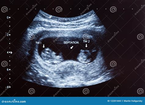 Ultrasound Scan Of 10 Weeks Old Twins Stock Images - Image: 12201444