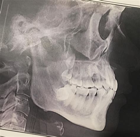 Short Face Syndrome : r/jawsurgery