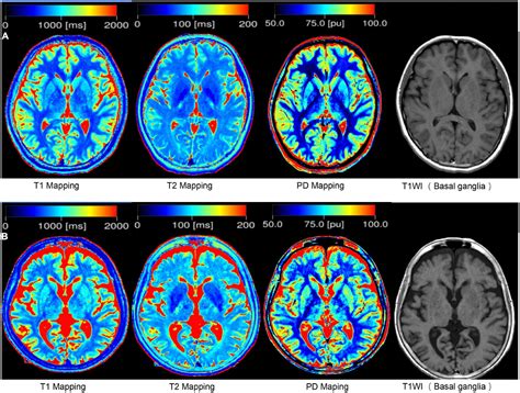 Frontiers | Prediction of brain age using quantitative parameters of synthetic magnetic ...