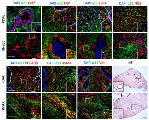 α11β1 Integrin is Induced in a Subset of Cancer-Associated Fibroblasts ...