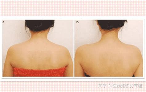 关于瘦肩针，你必须了解这些注意事项【许昌市人民医院整形美容外科】_肩膀