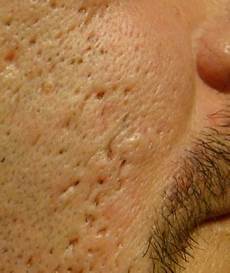 trou peau visage homme healthy n fit tips to treat holes on trou peau visage homme healthy n fit tips to treat holes on