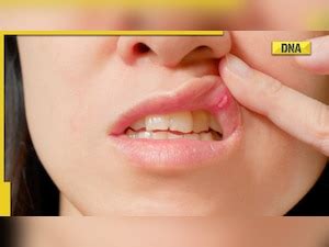 Mouth ulcer a sign of serious health conditions! Know about its causes ...
