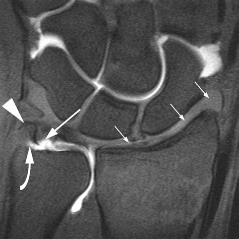 Peripheral Tear of the Triangular Fibrocartilage: Depiction with MR ...