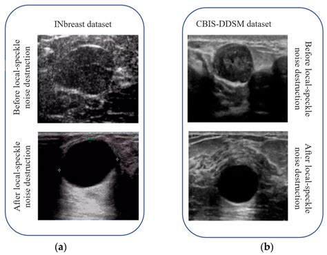 Image Noise Removal in Ultrasound Breast Images Based on Hybrid Deep ...