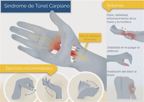 Síndrome de Túnel Carpiano - Neurocirugía de la Torre
