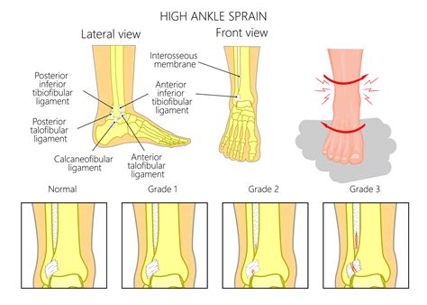 How To Rehab a High Ankle Sprain | [P]rehab