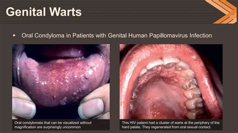 Genital Warts(HPV), Genital Herpes | PPTX