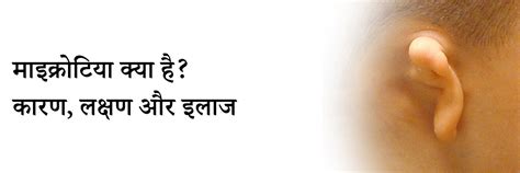 माइक्रोटिया क्या है? कारण, लक्षण और इलाज | Microtia in Hindi