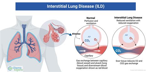 Interstitial Lung Disease | ChemoExperts