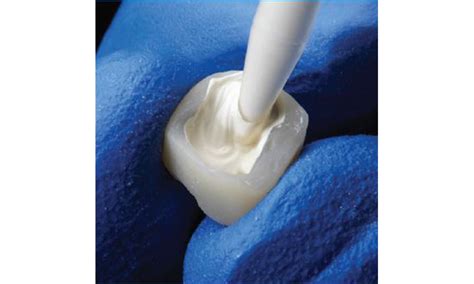 Integrity TempGrip: Temporary Crown Cement | Dentsply Sirona IN