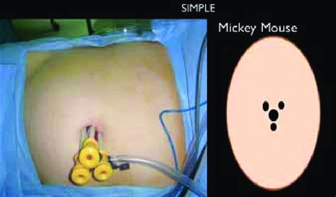 Image result for Mickey Button Procedure