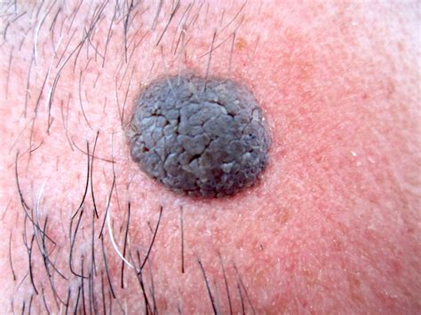 Black Mole Skin Cancer at Brenda Swindell blog