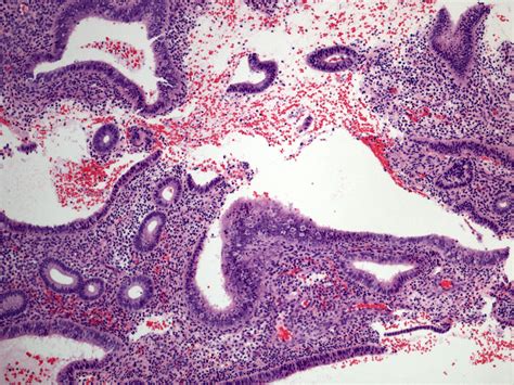 Proliferative Endometrium Histology