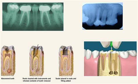 Chisel Dental Clinic | Root Canal Treatment