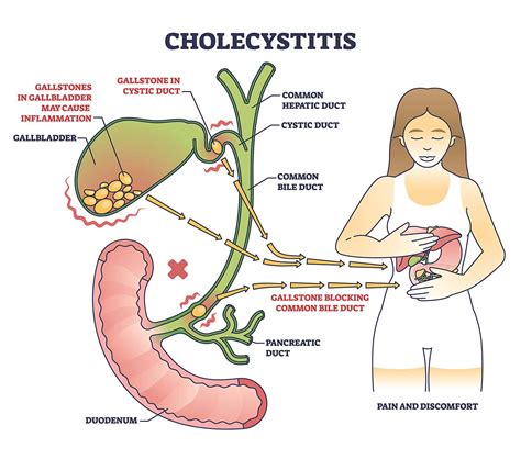 Cholecystitis and Gallstones Treatments | SCMSC