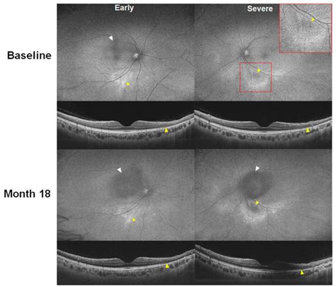 Atypical Presentations of Hydroxychloroquine Retinopathy: A Case Series ...