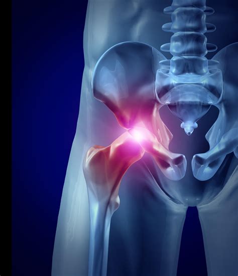 Hip Flexor Injury