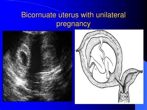 PPT - embryology &congeital anomalies of female genital tract ...