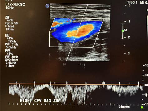 Vascular Sonography – Ultrasound Physics and its Application in Medicine