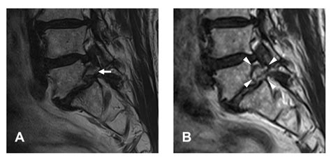 Full-Endoscopic Lumbar Foraminotomy for Foraminal Stenosis in ...