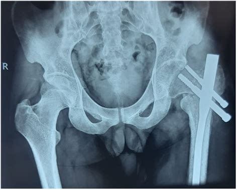 Role of Bipolar hemiarthroplasty in geriatric patients with hip implant ...