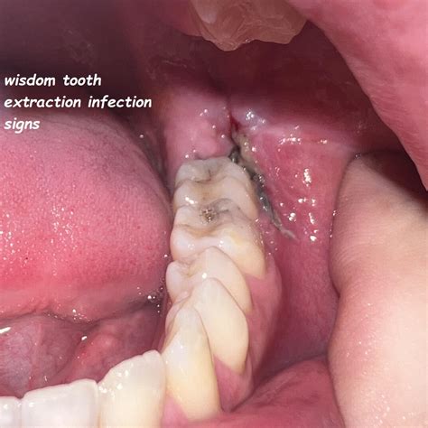 Extracted Wisdom Tooth 的图像结果