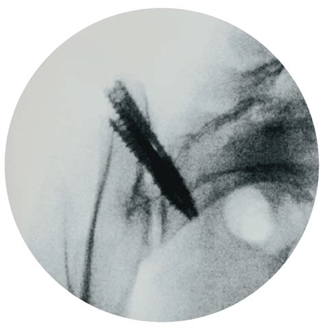 Image result for Contralateral Oblique View