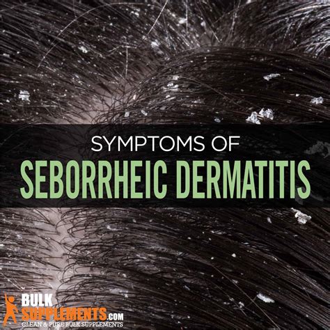 Seborrheic Dermatitis Scalp