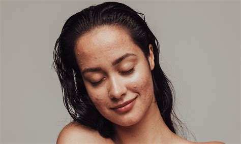 How to Reduce Bump on Forehead: Conquer Those Unwanted Bumps! - How to Get Rid of Face Scars ...