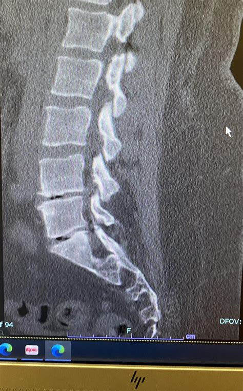 Disc replacement for L4-L5 & L5-S1? Any advice how to function with ...