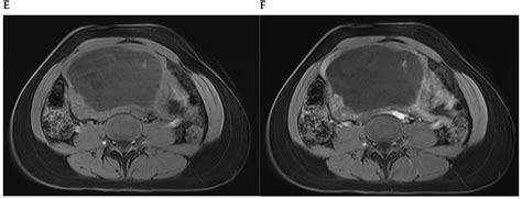 Hyaline and Cystic Degeneration of Uterine Leiomyomas: CT and MR ...