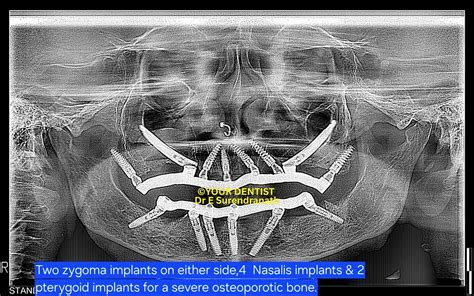 Zygomatic Implant Cost in Vijayawada | How to Get a Quote