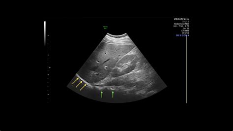 Normal Liver Ultrasound