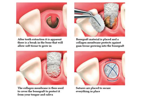 Tooth Extraction And Bone Graft - Dental News Network