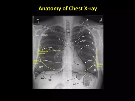 Chest X-ray Interpretation | PDF